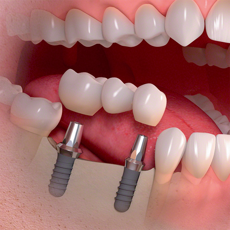 Implantatversorgung von mehreren Zähnen