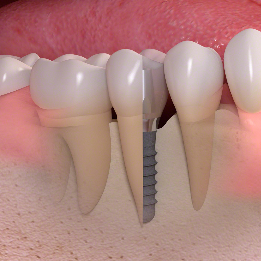 Implantatversorgung eines einzelnen Zahnes